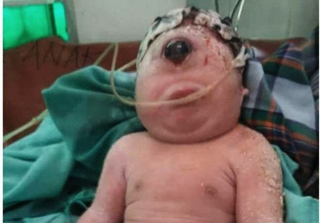 Bayi Perempuan Mirip &#8220;Dajjal&#8221; Lahir Bermata Satu Tanpa Hidung di Sumatera Utara